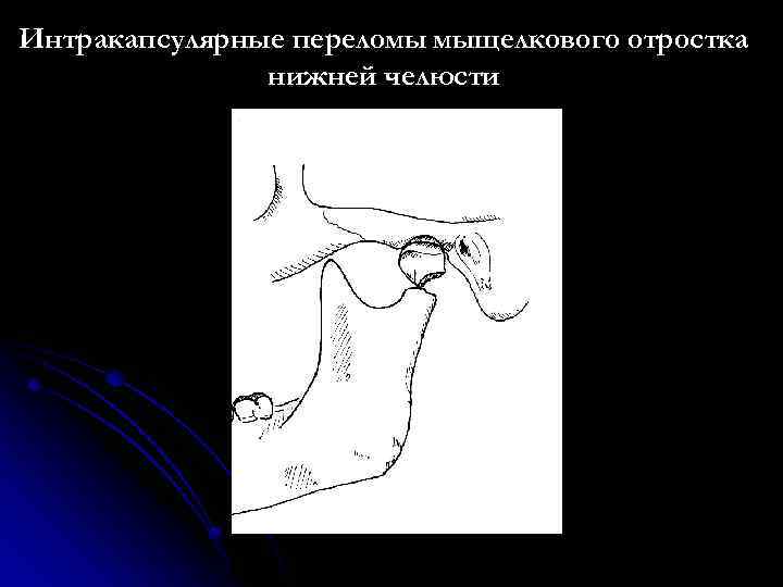 Перелом мыщелкового отростка нижней челюсти. Механизм перелома мыщелкового отростка нижней челюсти. Перелом суставного отростка нижней челюсти. Перелом венечного отростка челюсти кт. Перелом шейки мыщелкового отростка.