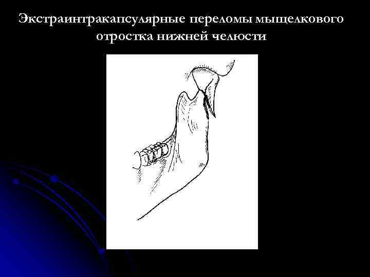 Экстраинтракапсулярные переломы мыщелкового отростка нижней челюсти 