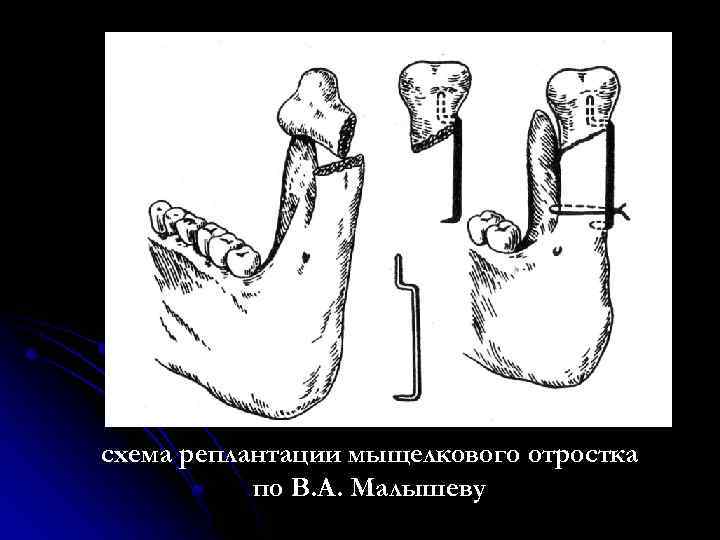 Перелом мыщелкового отростка нижней челюсти. Реплантация конечностей. Вывих мыщелкового отростка нижней челюсти. Ампутация и реплантация. Протез мыщелкового отростка.