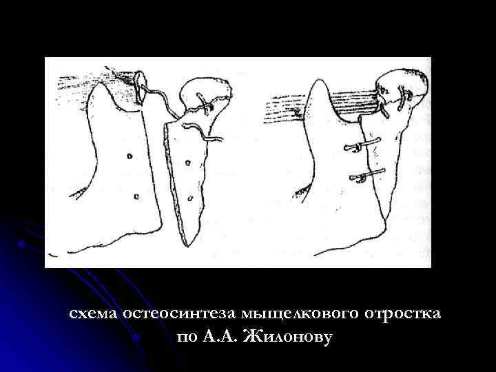 схема остеосинтеза мыщелкового отростка по А. А. Жилонову 