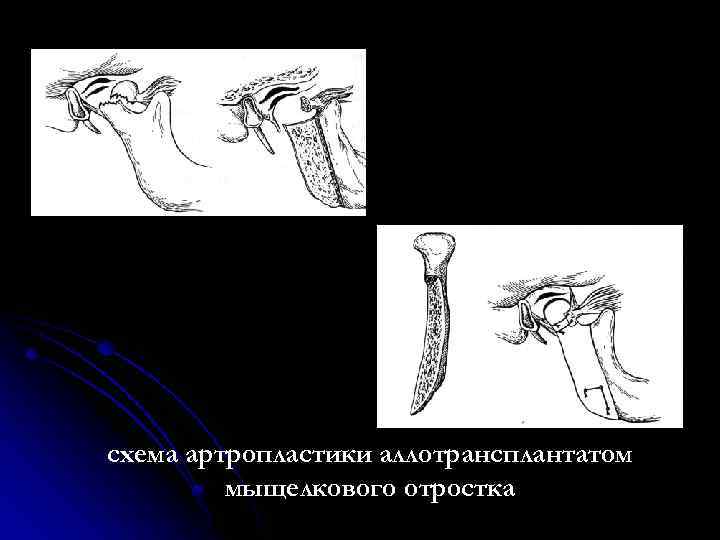 схема артропластики аллотрансплантатом мыщелкового отростка 