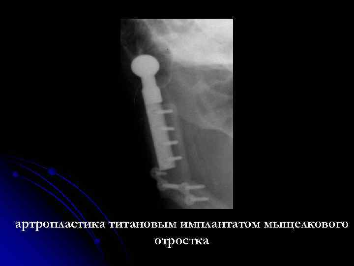 артропластика титановым имплантатом мыщелкового отростка 