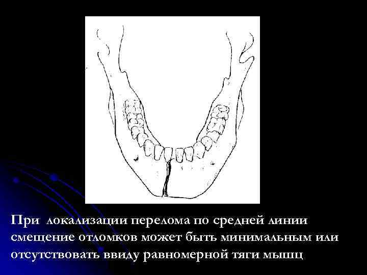 При локализации перелома по средней линии смещение отломков может быть минимальным или отсутствовать ввиду