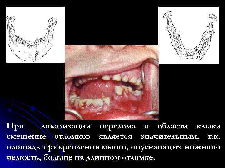 При локализации перелома в области клыка смещение отломков является значительным, т. к. площадь прикрепления