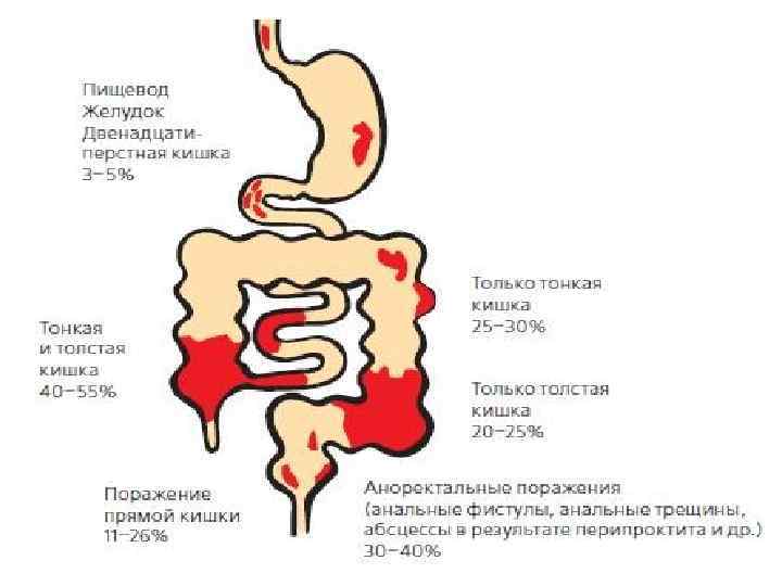 Синдром кишечной диспепсии дифференциальная диагностика