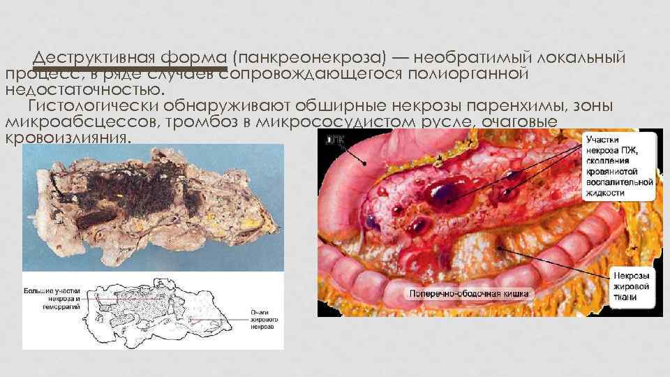 Деструктивная форма (панкреонекроза) — необратимый локальный процесс, в ряде случаев сопровождающегося полиорганной недостаточностью. Гистологически