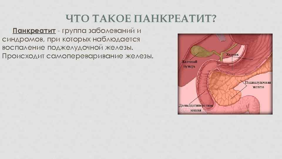 ЧТО ТАКОЕ ПАНКРЕАТИТ? Панкреатит - группа заболеваний и синдромов, при которых наблюдается воспаление поджелудочной