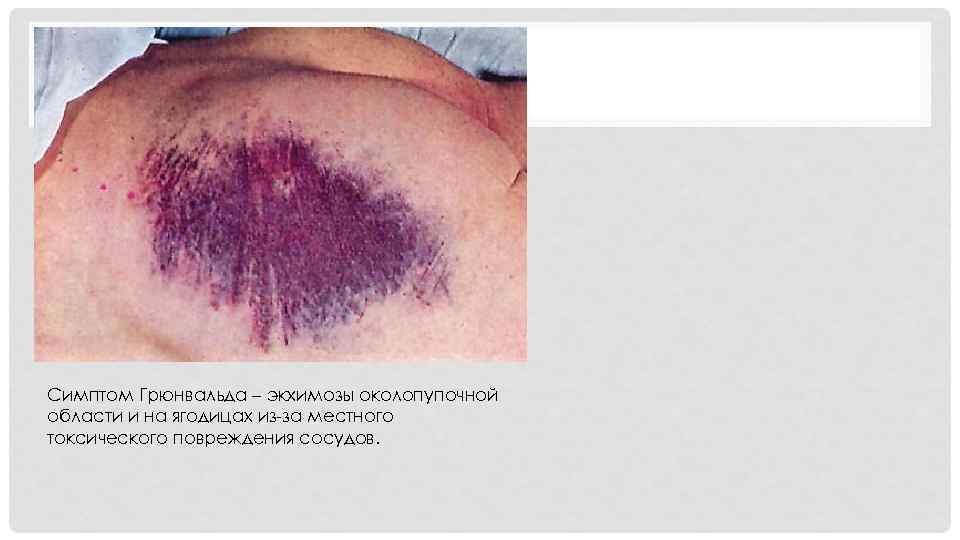 Симптом Грюнвальда – экхимозы околопупочной области и на ягодицах из-за местного токсического повреждения сосудов.