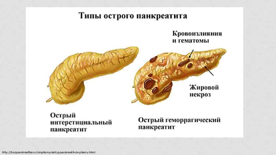 http: //bezpankreatita. ru/simptomy/ostryj-pankreatit-simptomy. html 