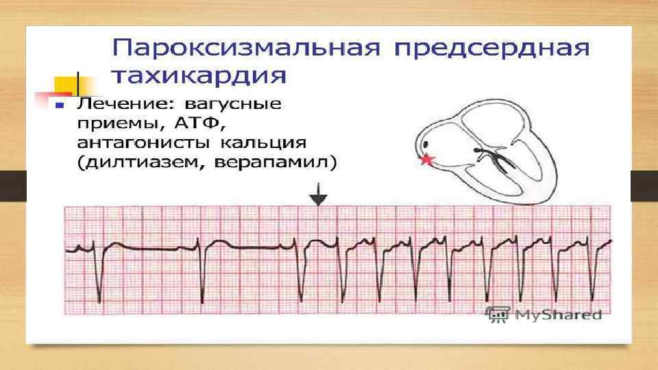 Пароксизмальная тахикардия у детей презентация