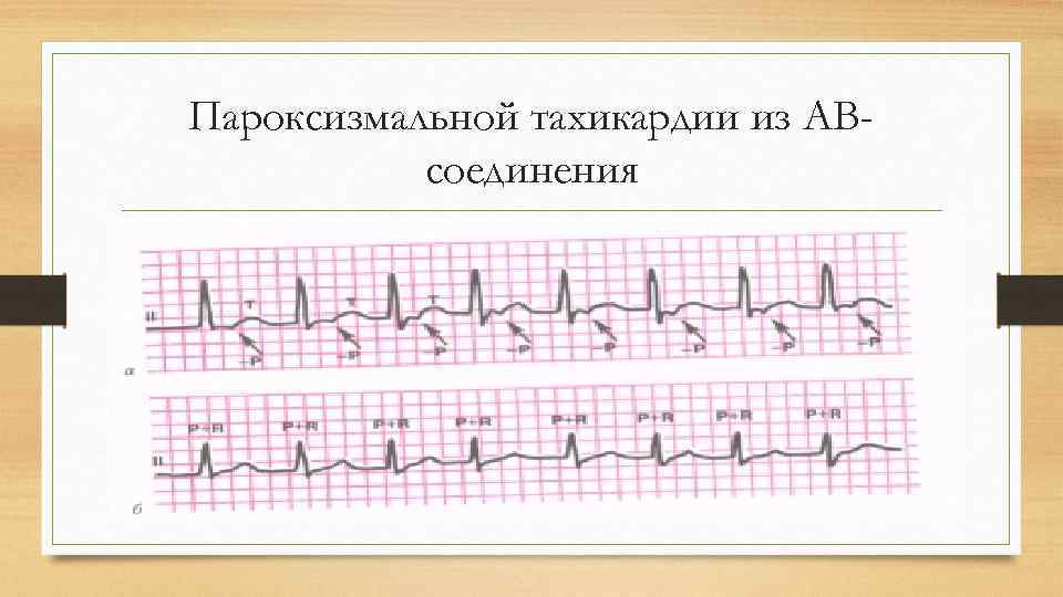 Пароксизмальной тахикардии из АВсоединения 
