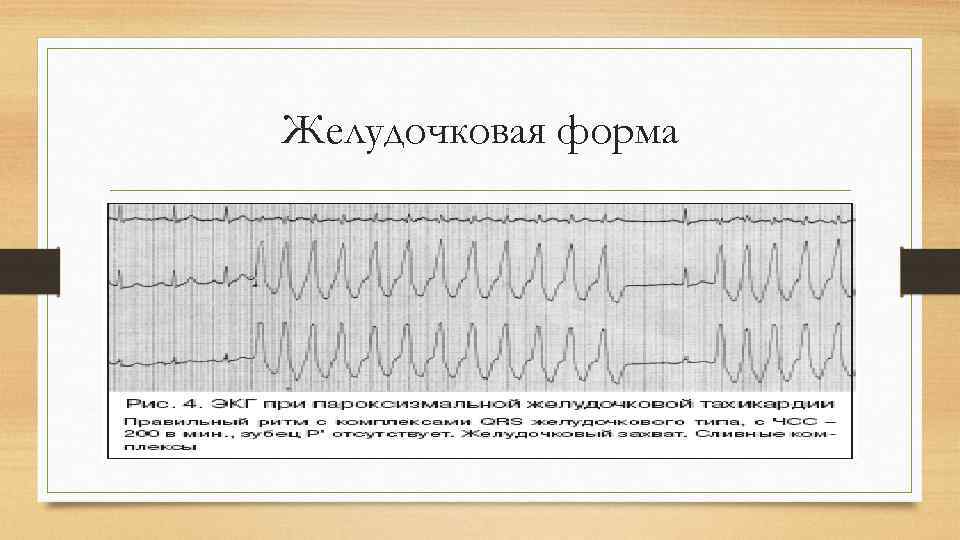 Желудочковая форма 