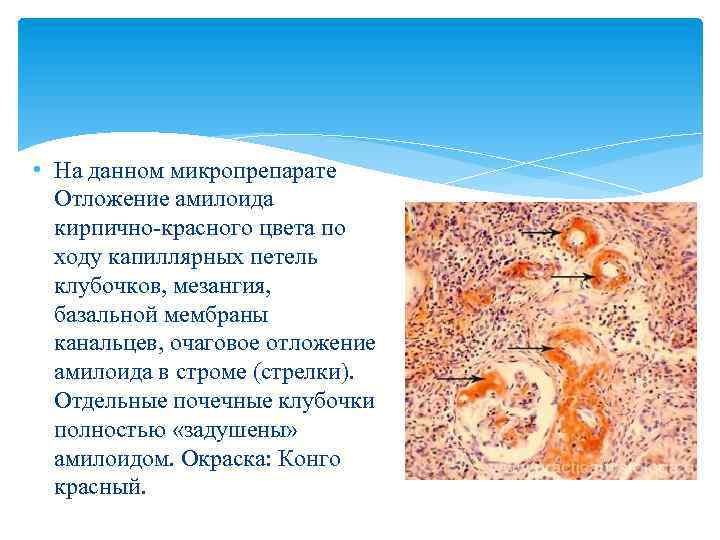  • На данном микропрепарате Отложение амилоида кирпично красного цвета по ходу капиллярных петель