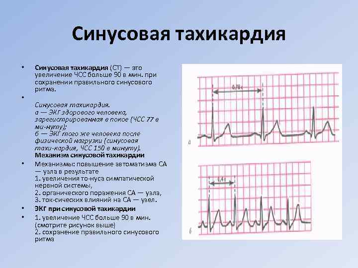 Синусовая тахикардия • • • Синусовая тахикардия (СТ) — это увеличение ЧСС больше 90