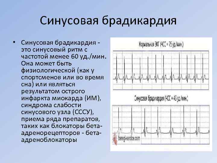 Синусовая брадикардия • Синусовая брадикардия это синусовый ритм с частотой менее 60 уд. /мин.