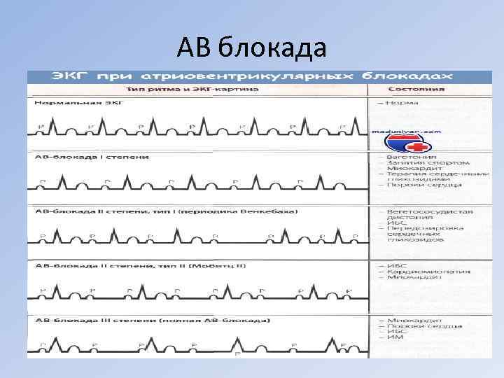 АВ блокада 