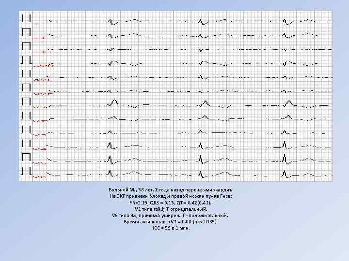 Больной М. , 38 лет. 2 года назад перенес миокардит. На ЭКГ признаки блокады