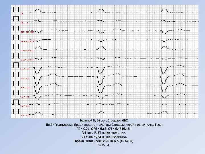 Больной К, 58 лет. Страдает ИБС. На ЭКГ: синусовыя брадикардия, признаки блокады левой ножки