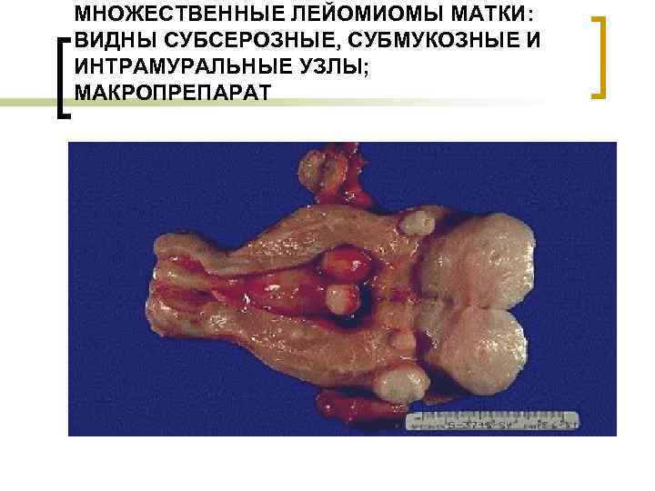 МНОЖЕСТВЕННЫЕ ЛЕЙОМИОМЫ МАТКИ: ВИДНЫ СУБСЕРОЗНЫЕ, СУБМУКОЗНЫЕ И ИНТРАМУРАЛЬНЫЕ УЗЛЫ; МАКРОПРЕПАРАТ 