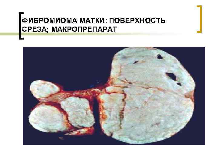 ФИБРОМИОМА МАТКИ: ПОВЕРХНОСТЬ СРЕЗА; МАКРОПРЕПАРАТ 