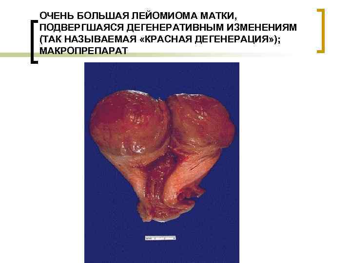 ОЧЕНЬ БОЛЬШАЯ ЛЕЙОМИОМА МАТКИ, ПОДВЕРГШАЯСЯ ДЕГЕНЕРАТИВНЫМ ИЗМЕНЕНИЯМ (ТАК НАЗЫВАЕМАЯ «КРАСНАЯ ДЕГЕНЕРАЦИЯ» ); МАКРОПРЕПАРАТ 
