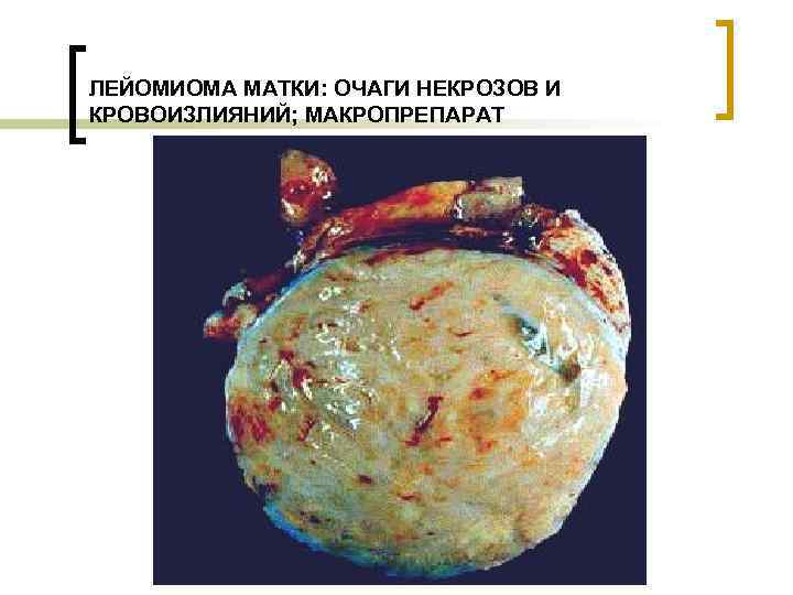 ЛЕЙОМИОМА МАТКИ: ОЧАГИ НЕКРОЗОВ И КРОВОИЗЛИЯНИЙ; МАКРОПРЕПАРАТ 