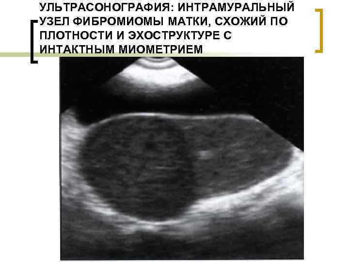 УЛЬТРАСОНОГРАФИЯ: ИНТРАМУРАЛЬНЫЙ УЗЕЛ ФИБРОМИОМЫ МАТКИ, СХОЖИЙ ПО ПЛОТНОСТИ И ЭХОСТРУКТУРЕ С ИНТАКТНЫМ МИОМЕТРИЕМ 