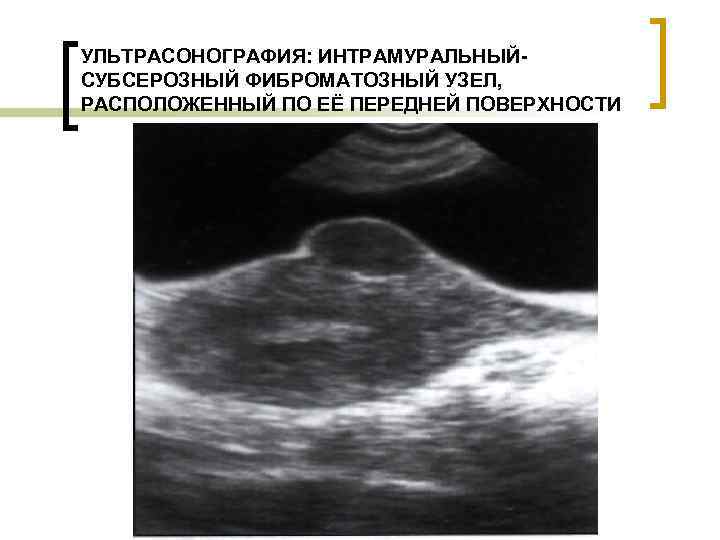 УЛЬТРАСОНОГРАФИЯ: ИНТРАМУРАЛЬНЫЙСУБСЕРОЗНЫЙ ФИБРОМАТОЗНЫЙ УЗЕЛ, РАСПОЛОЖЕННЫЙ ПО ЕЁ ПЕРЕДНЕЙ ПОВЕРХНОСТИ 