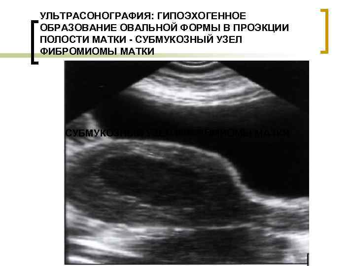 УЛЬТРАСОНОГРАФИЯ: ГИПОЭХОГЕННОЕ ОБРАЗОВАНИЕ ОВАЛЬНОЙ ФОРМЫ В ПРОЭКЦИИ ПОЛОСТИ МАТКИ - СУБМУКОЗНЫЙ УЗЕЛ ФИБРОМИОМЫ МАТКИ