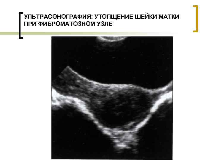 УЛЬТРАСОНОГРАФИЯ: УТОЛЩЕНИЕ ШЕЙКИ МАТКИ ПРИ ФИБРОМАТОЗНОМ УЗЛЕ 