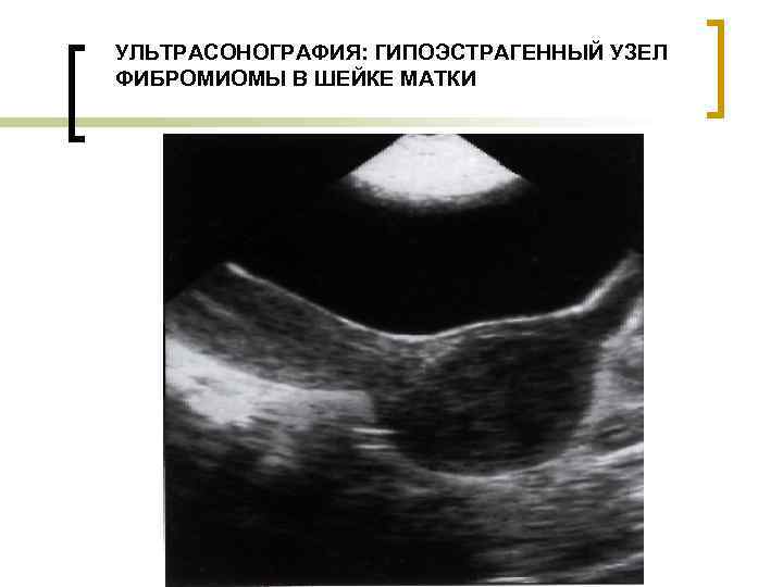 УЛЬТРАСОНОГРАФИЯ: ГИПОЭСТРАГЕННЫЙ УЗЕЛ ФИБРОМИОМЫ В ШЕЙКЕ МАТКИ 