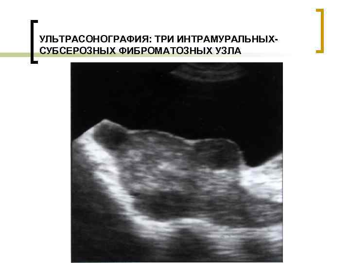 УЛЬТРАСОНОГРАФИЯ: ТРИ ИНТРАМУРАЛЬНЫХСУБСЕРОЗНЫХ ФИБРОМАТОЗНЫХ УЗЛА 