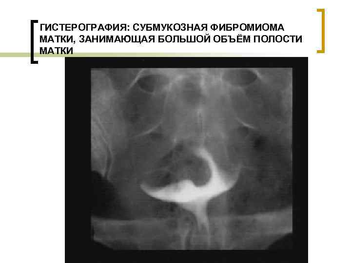 ГИСТЕРОГРАФИЯ: СУБМУКОЗНАЯ ФИБРОМИОМА МАТКИ, ЗАНИМАЮЩАЯ БОЛЬШОЙ ОБЪЁМ ПОЛОСТИ МАТКИ 