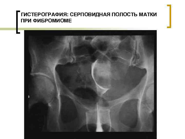 ГИСТЕРОГРАФИЯ: СЕРПОВИДНАЯ ПОЛОСТЬ МАТКИ ПРИ ФИБРОМИОМЕ 