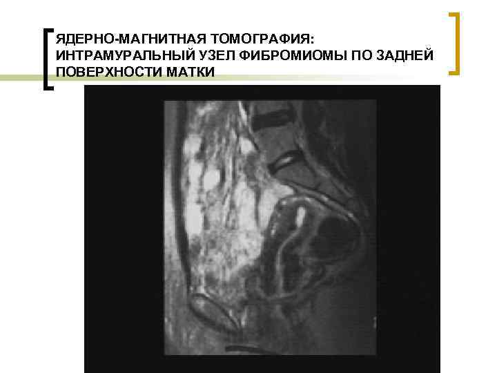 ЯДЕРНО-МАГНИТНАЯ ТОМОГРАФИЯ: ИНТРАМУРАЛЬНЫЙ УЗЕЛ ФИБРОМИОМЫ ПО ЗАДНЕЙ ПОВЕРХНОСТИ МАТКИ 