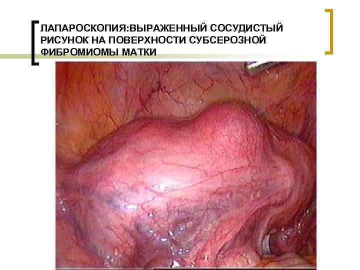 ЛАПАРОСКОПИЯ: ВЫРАЖЕННЫЙ СОСУДИСТЫЙ РИСУНОК НА ПОВЕРХНОСТИ СУБСЕРОЗНОЙ ФИБРОМИОМЫ МАТКИ 