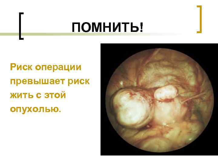 ПОМНИТЬ! Риск операции превышает риск жить с этой опухолью. 