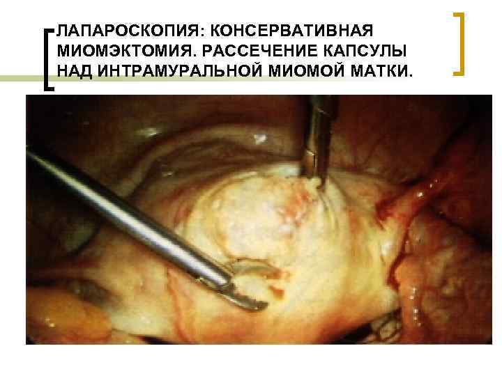 ЛАПАРОСКОПИЯ: КОНСЕРВАТИВНАЯ МИОМЭКТОМИЯ. РАССЕЧЕНИЕ КАПСУЛЫ НАД ИНТРАМУРАЛЬНОЙ МИОМОЙ МАТКИ. 