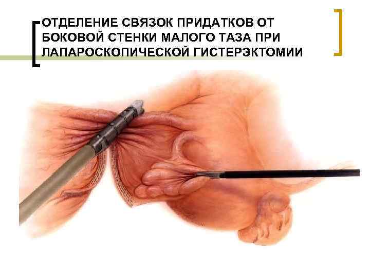 ОТДЕЛЕНИЕ СВЯЗОК ПРИДАТКОВ ОТ БОКОВОЙ СТЕНКИ МАЛОГО ТАЗА ПРИ ЛАПАРОСКОПИЧЕСКОЙ ГИСТЕРЭКТОМИИ 