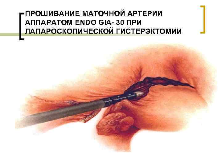 ПРОШИВАНИЕ МАТОЧНОЙ АРТЕРИИ АППАРАТОМ ENDO GIA- 30 ПРИ ЛАПАРОСКОПИЧЕСКОЙ ГИСТЕРЭКТОМИИ 