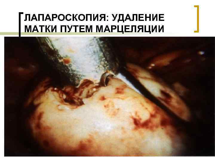 ЛАПАРОСКОПИЯ: УДАЛЕНИЕ МАТКИ ПУТЕМ МАРЦЕЛЯЦИИ 