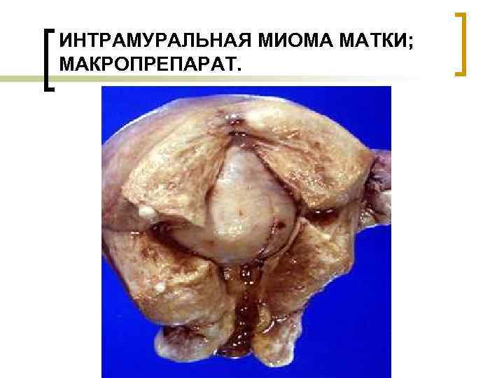 ИНТРАМУРАЛЬНАЯ МИОМА МАТКИ; МАКРОПРЕПАРАТ. 
