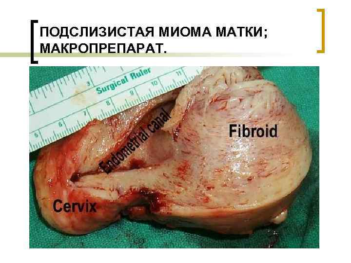 ПОДСЛИЗИСТАЯ МИОМА МАТКИ; МАКРОПРЕПАРАТ. 