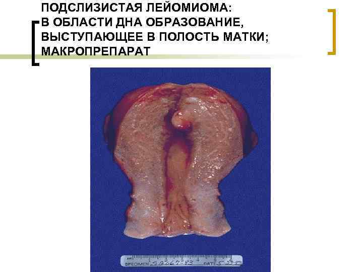 ПОДСЛИЗИСТАЯ ЛЕЙОМИОМА: В ОБЛАСТИ ДНА ОБРАЗОВАНИЕ, ВЫСТУПАЮЩЕЕ В ПОЛОСТЬ МАТКИ; МАКРОПРЕПАРАТ 