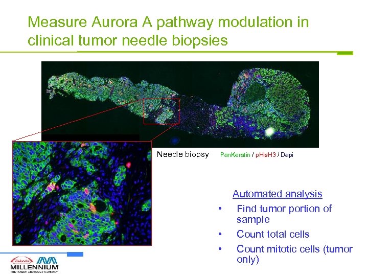 Measure Aurora A pathway modulation in clinical tumor needle biopsies Needle biopsy Pan. Keratin