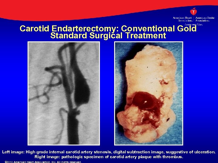 Carotid Endarterectomy: Conventional Gold Standard Surgical Treatment Left image: High grade internal carotid artery