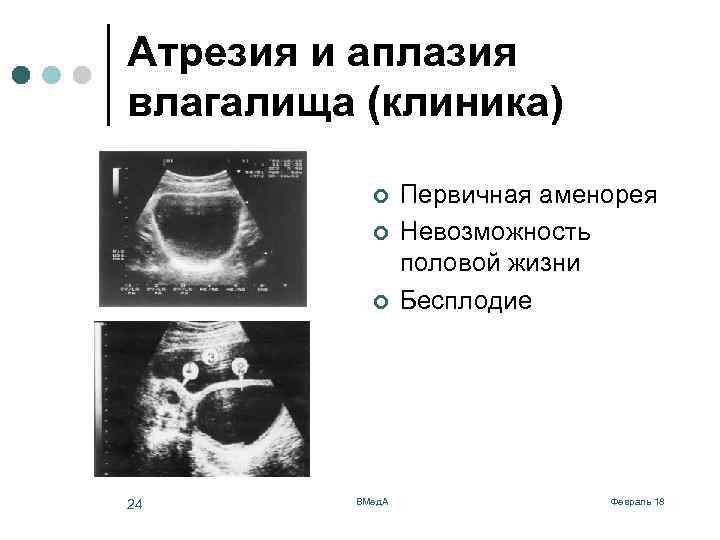 Атрезия и аплазия влагалища (клиника) ¢ ¢ ¢ 24 ВМед. А Первичная аменорея Невозможность