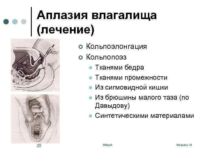 Аплазия влагалища (лечение) ¢ ¢ Кольпоэлонгация Кольпопоэз l l l 25 Тканями бедра Тканями