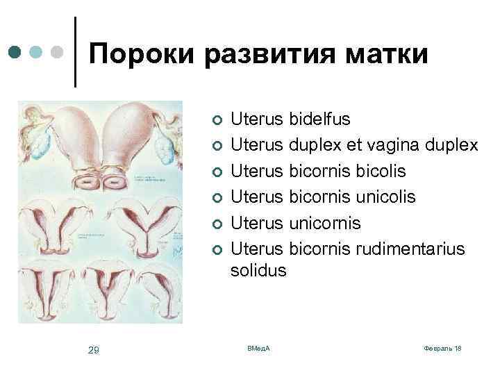 Пороки развития матки ¢ ¢ ¢ 29 Uterus bidelfus Uterus duplex et vagina duplex