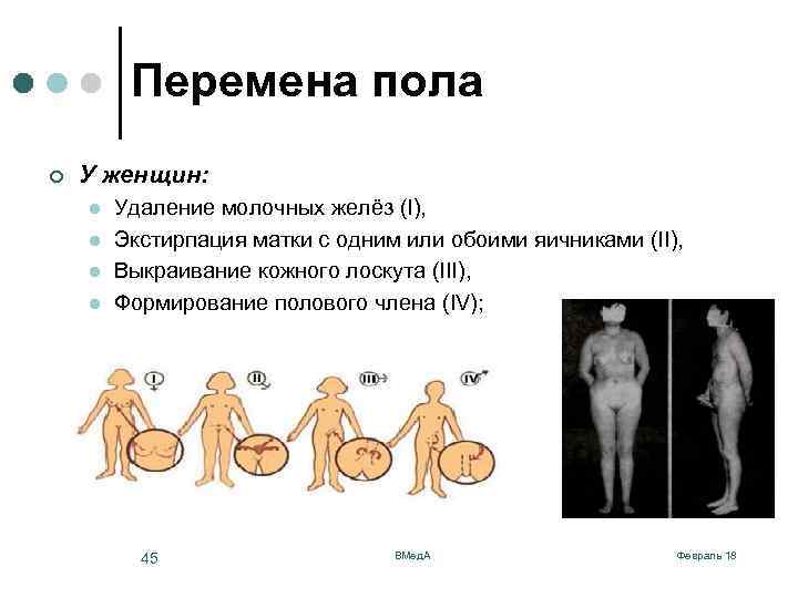 Перемена пола ¢ У женщин: l l Удаление молочных желёз (I), Экстирпация матки с